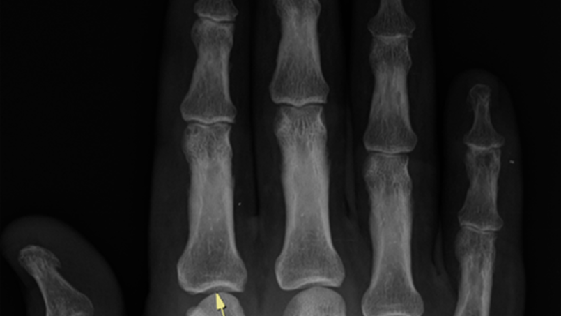 ¿La cirugía de artrosis del pulgar puede causar tendinitis? Lo que revela un nuevo estudio